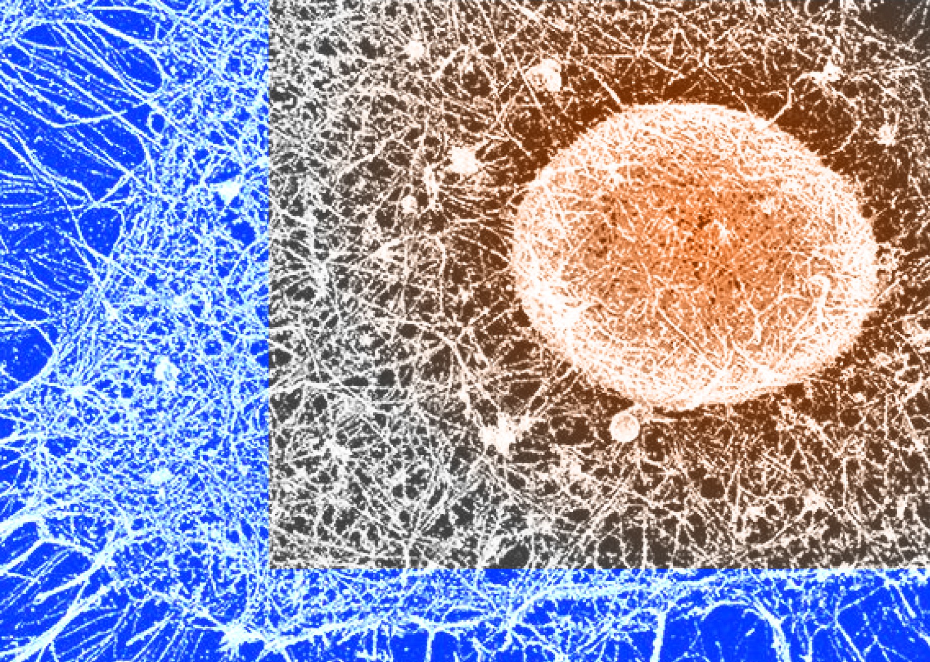 Neuromorphic brain prosthetics